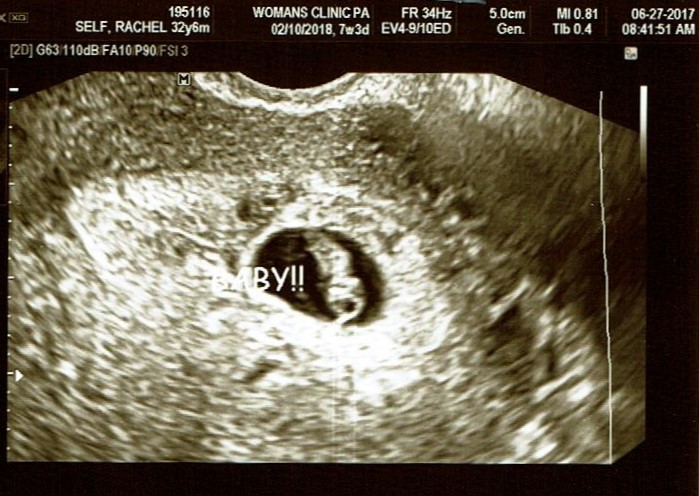 Anna's Ultrasound Pic